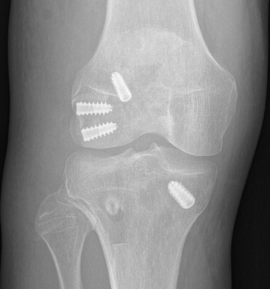 ACL + posterolateral corner reconstruction 1